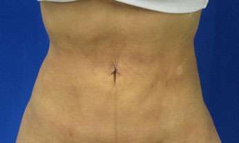 Liposuction Before & After Patient #9428