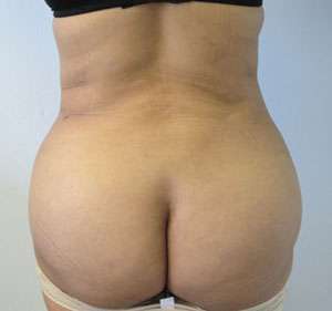 Liposuction Before & After Patient #9434