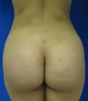 Liposuction Before & After Patient #9439