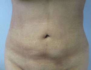 Liposuction Before & After Patient #9442