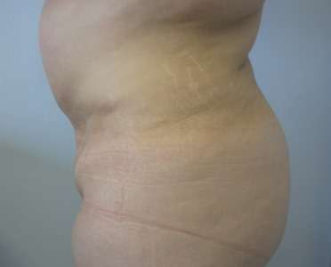 Liposuction Before & After Patient #9445