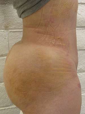 Brazilian Butt Lift Before & After Patient #6248