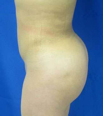 Liposuction Before & After Patient #9448