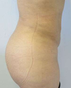 Liposuction Before & After Patient #9454