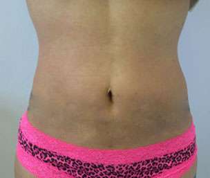 Liposuction Before & After Patient #9457