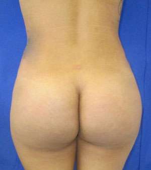 Liposuction Before & After Patient #9467