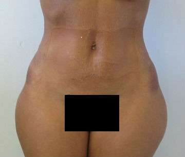 Liposuction Before & After Patient #9472