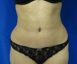 Liposuction Before & After Patient #9475