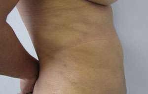 Liposuction Before & After Patient #9481