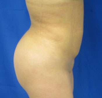 Liposuction Before & After Patient #9487