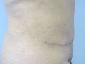Liposuction Before & After Patient #9490