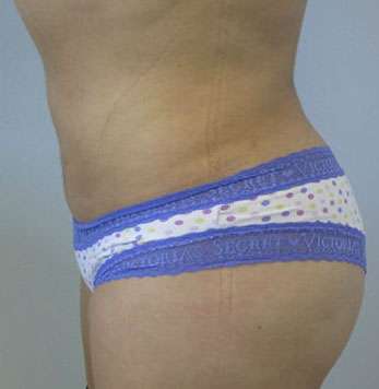 Liposuction Before & After Patient #9493