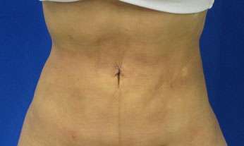 Liposuction Before & After Patient #9496