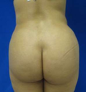Liposuction Before & After Patient #9499