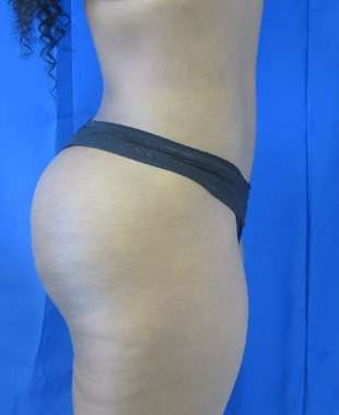 Liposuction Before & After Patient #9502