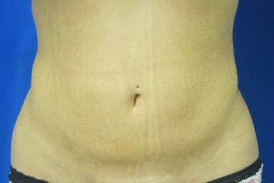 Liposuction Before & After Patient #9505