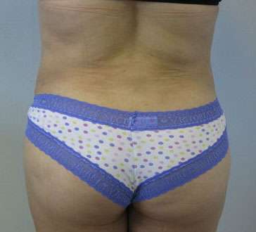 Liposuction Before & After Patient #9514