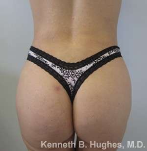 Liposuction Before & After Patient #9519