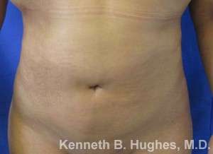 Liposuction Before & After Patient #9522