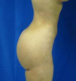 Liposuction Before & After Patient #9525