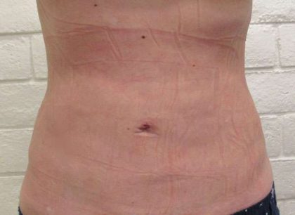 Liposuction Revision Cellulite Reduction Before & After Patient #9531