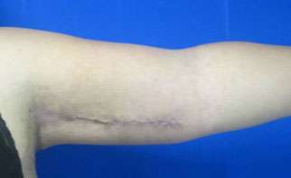 Arm Lift Before & After Patient #5940