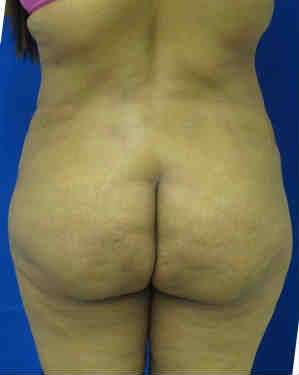 Brazilian Butt Lift Before & After Patient #6814