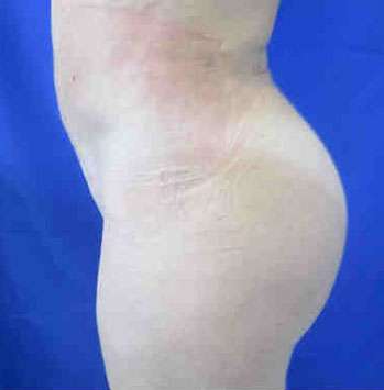 Brazilian Butt Lift Before & After Patient #6819
