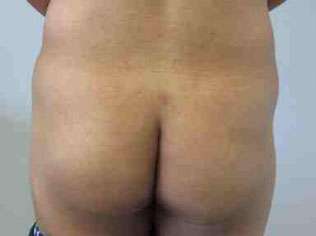 Brazilian Butt Lift Before & After Patient #6830