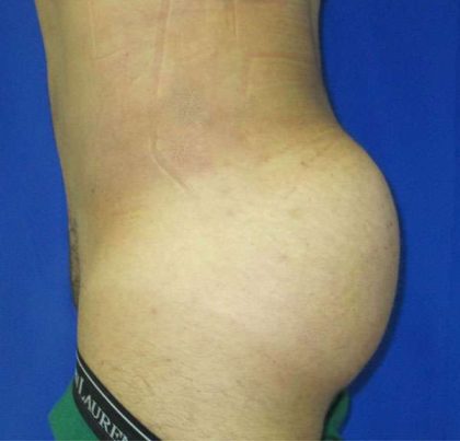 Brazilian Butt Lift Before & After Patient #6835