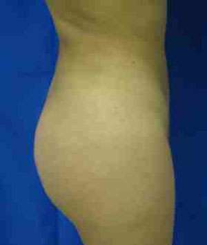 Brazilian Butt Lift Before & After Patient #6849
