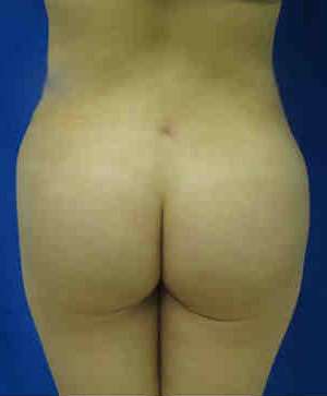 Brazilian Butt Lift Before & After Patient #6873