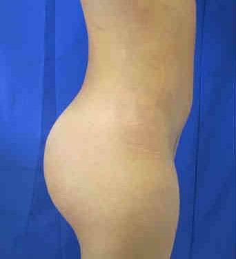 Brazilian Butt Lift Before & After Patient #6878