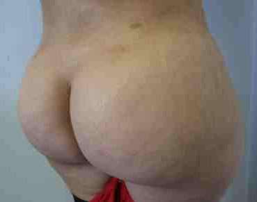 Brazilian Butt Lift Before & After Patient #6903