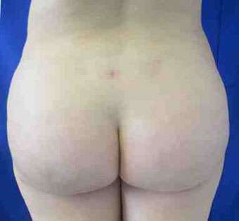 Brazilian Butt Lift Before & After Patient #6919