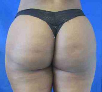 Brazilian Butt Lift Before & After Patient #6930