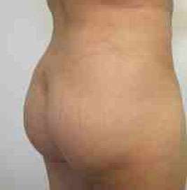 Brazilian Butt Lift Before & After Patient #6945