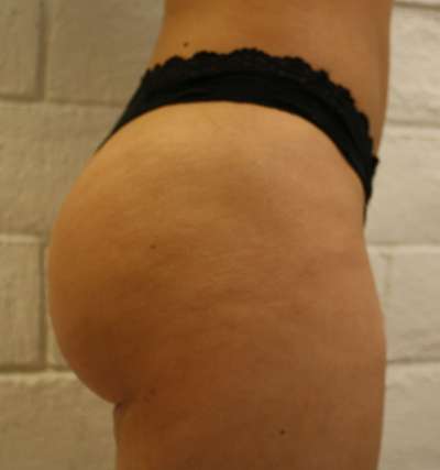 Brazilian Butt Lift Before & After Patient #6987