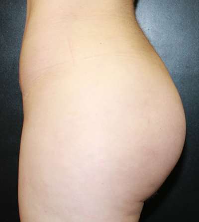 Brazilian Butt Lift Before & After Patient #6995