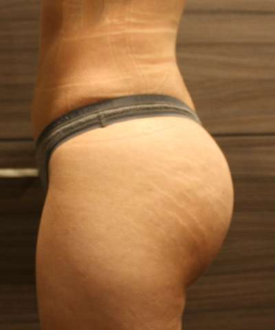 Brazilian Butt Lift for Thinner Patients Before & After Patient #7021
