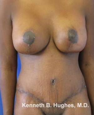 Breast Augmentation and Lift Before & After Patient #7041