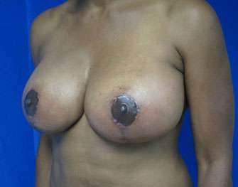 Breast Augmentation and Lift Before & After Patient #7164
