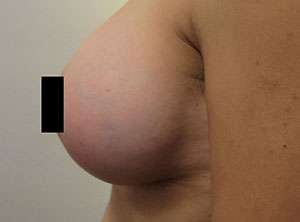 Breast Augmentation and Lift Before & After Patient #7177