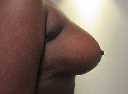 Breast Augmentation and Lift Before & After Patient #7184