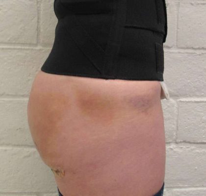 Body Lift Before & After Patient #5963