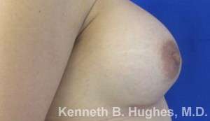Breast Augmentation Implants Before & After Patient #7236