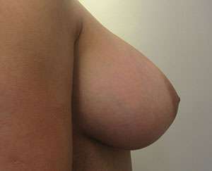 Breast Augmentation Implants Before & After Patient #7618