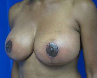 Breast Lift Before & After Patient #7927