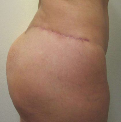 Body Lift Before & After Patient #5982