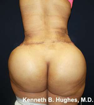 Butt Implants Before & After Patient #8134
